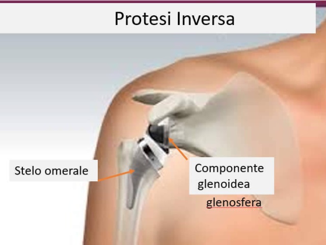 Artroprotesi inversa della spalla