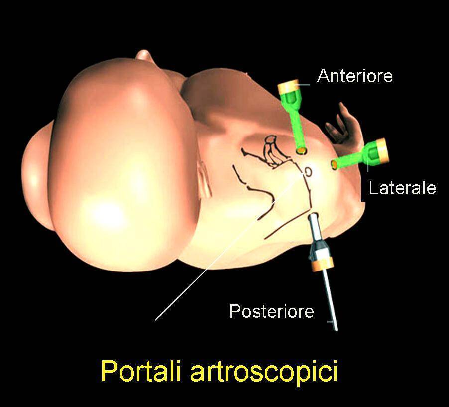 Riparazione artroscopica della cuffia dei rotatori