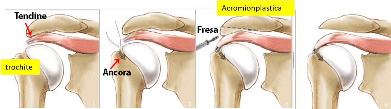 Riparazione artroscopica cuffia rotatori