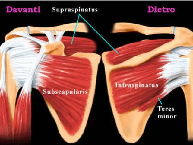 Lesione della cuffia dei rotatori