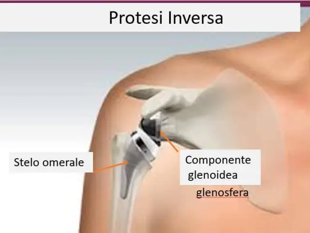 Artroprotesi inversa della spalla