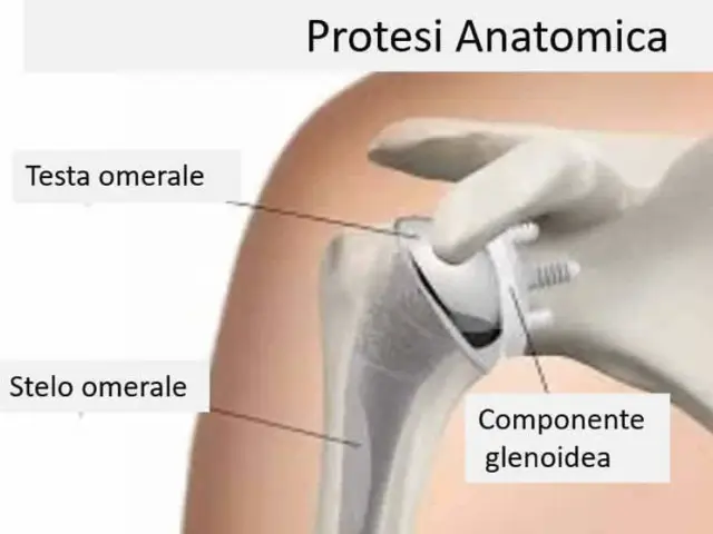 Artroprotesi anatomica della spalla